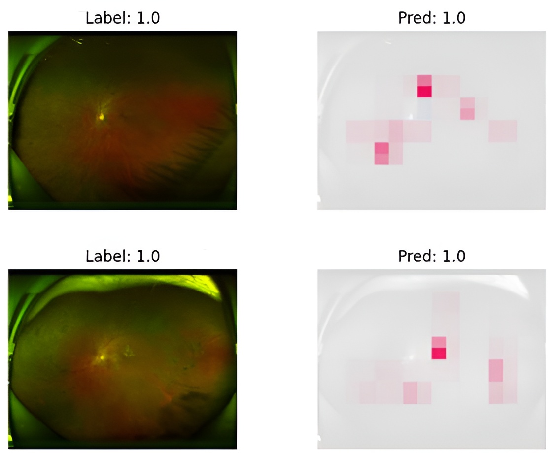 Diabetische Retinopathie Erkennungsvisualisierung